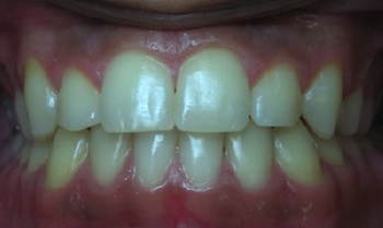 Anterior Crossbite After