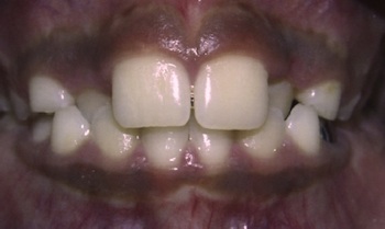 Anterior Crossbite Before