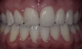 Anterior Openbite After