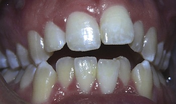 Anterior Openbite Before