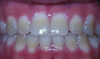 Asymmetric Underbite After