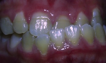 Asymmetric Underbite Before