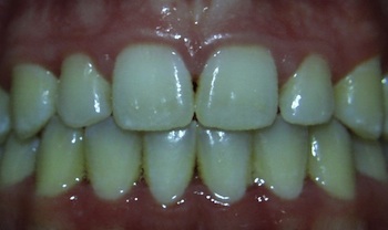 Posterior Crossbite Anterior Openbite After