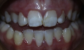 Posterior Crossbite Anterior Openbite Before